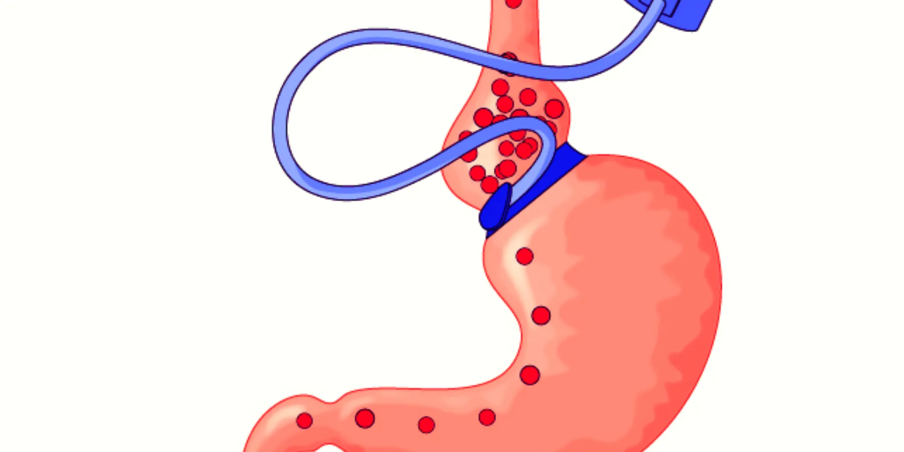 bariatric surgery