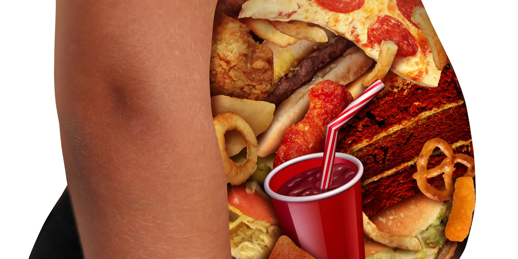 obesity