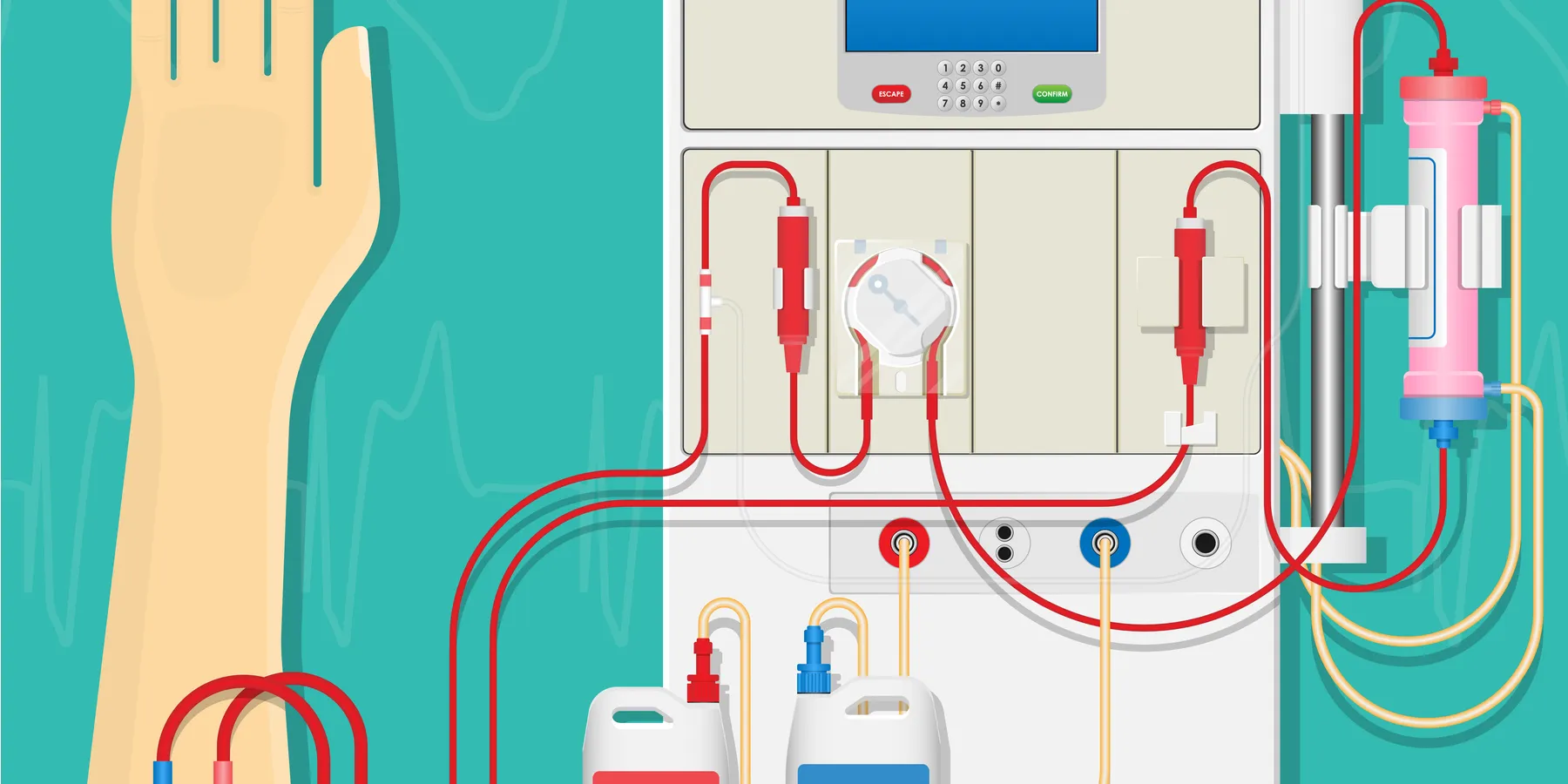 hemodialysis