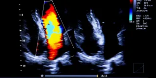 ultrasound