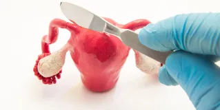 salpingectomy