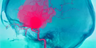 cerebral aneurysm