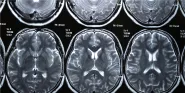 neuroimaging