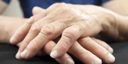 rheumatoid arthritis