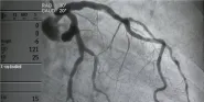 cardiac catherization