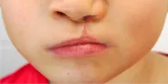 cleft palate